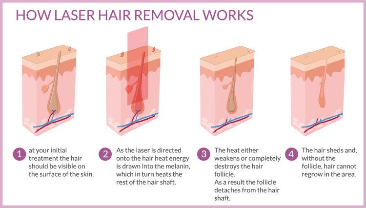 SHR Hair Removal machine