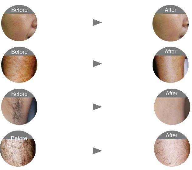 Sanhe IPL Hair Removal Machine Sanhe IPL Hair Removal Machine