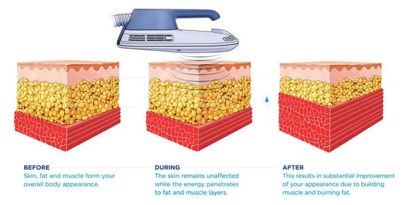 Emsculpt muscle building burn fat