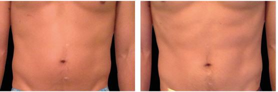 Emsculpt muscle building burn fat