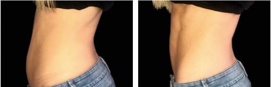 Emsculpt muscle building burn fat